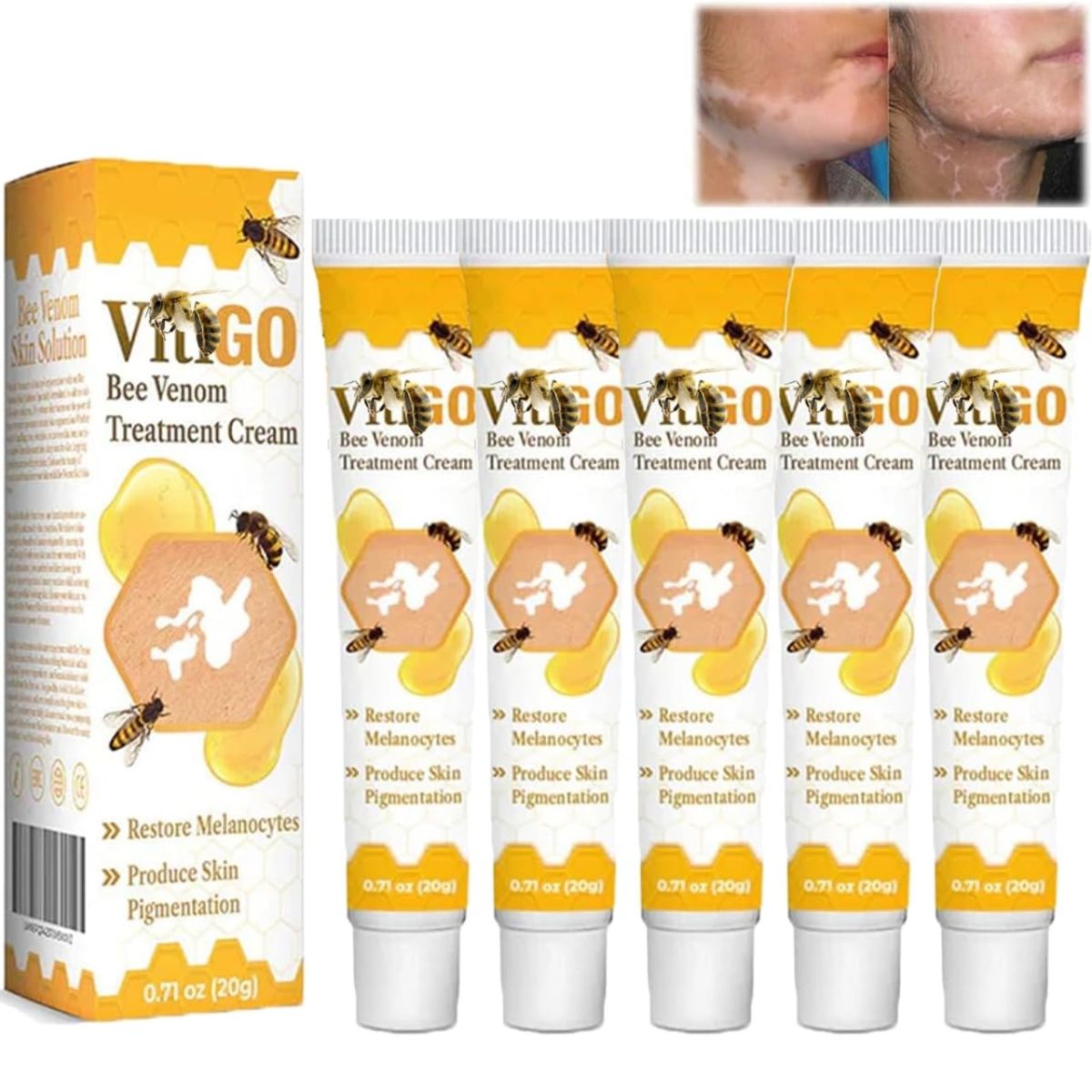 Bee Venom Vitiligo Treatment Cream - Restore Melanocytes & Skin Pigmentation - Natural Melanin Care Ointment for Leukoplakia (20g) View Gallery - Pakistan