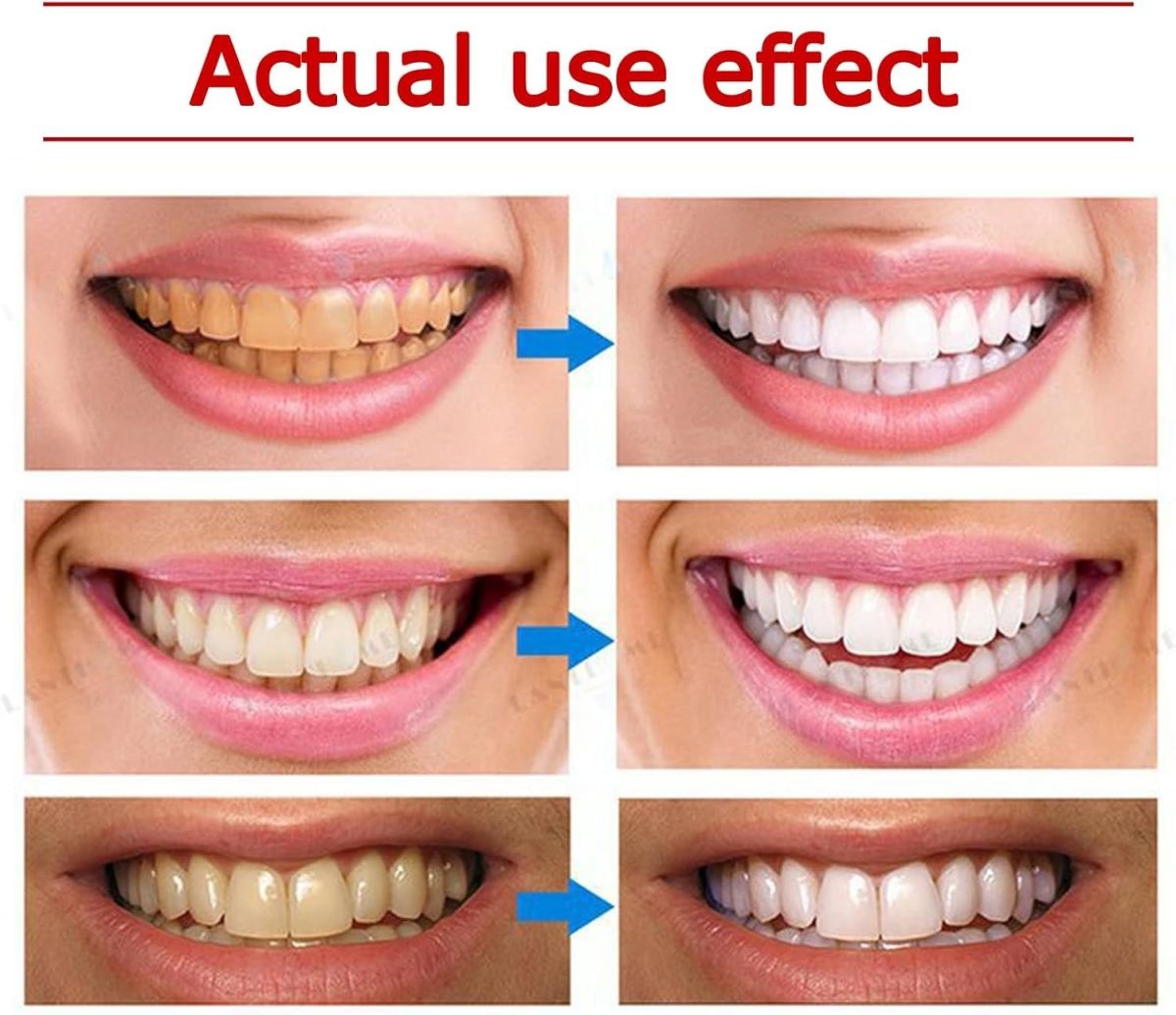 Yayashi SP-4 Ultra Whitening Toothpaste – 150ml Probiotic Stain Remover for Bright, Healthy Teeth View Gallery - Pakistan