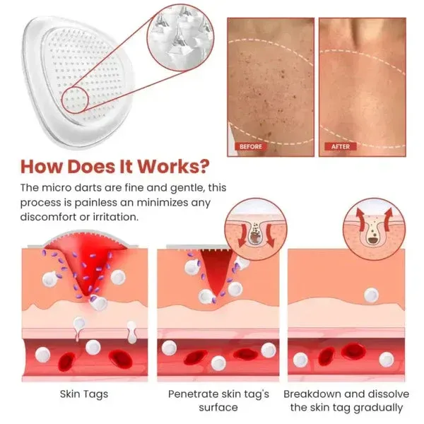 DermaSmooth Skin Tag Remover Patch – Fast, Safe, And Painless Skin Tag And Mole Removal Solution With No Scarring Or Pigmentation View Gallery - Pakistan
