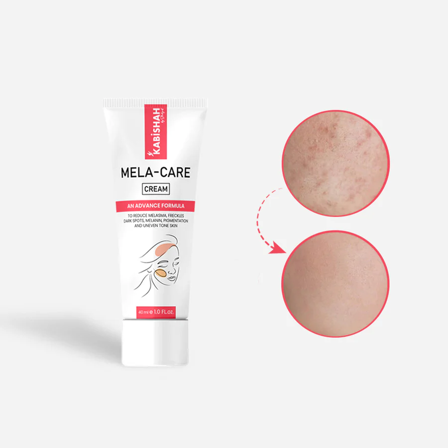 Kabishah Mela-Care Cream Advanced Formula For Melasma, Freckles, Dark Spots, And Uneven Skin Tone 50ml View Gallery - Pakistan