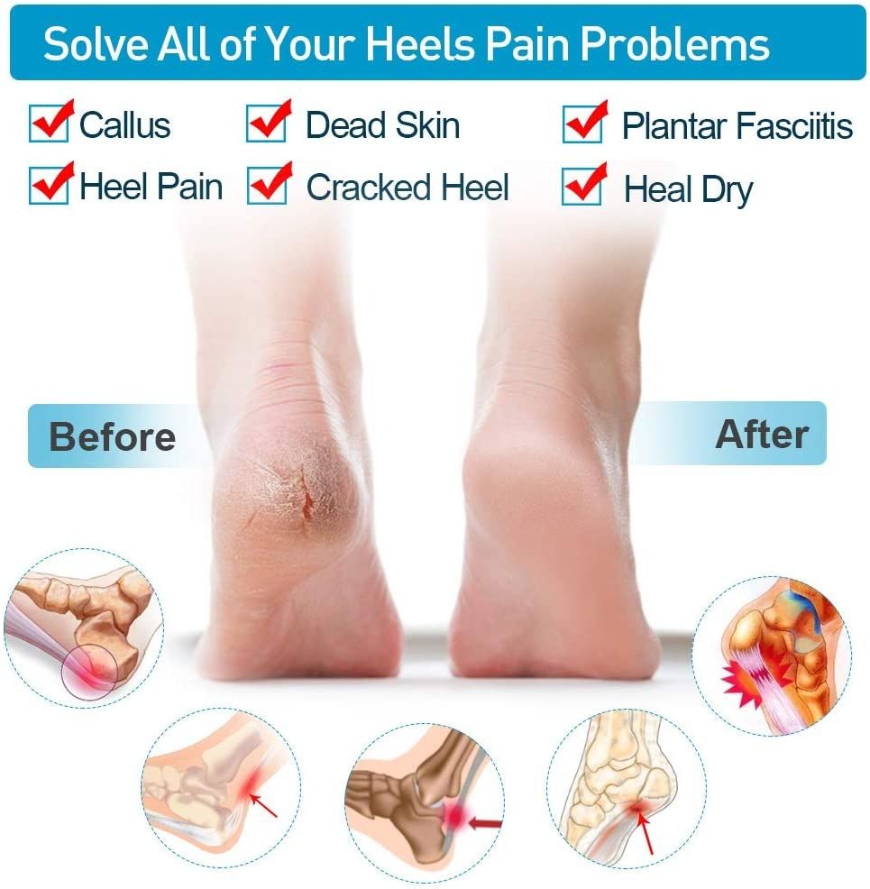 Silicone Heel Protector Sleeve for Cracked Heels & Pain Relief – Breathable & Cushioned Support View Gallery - Pakistan