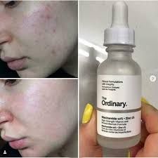 The Ordinary Niacinamide 10% + Zinc 1 % - 30ml |Oil Control, Pore Minimizing &amp; Blemish Solution Serum View Gallery - Pakistan