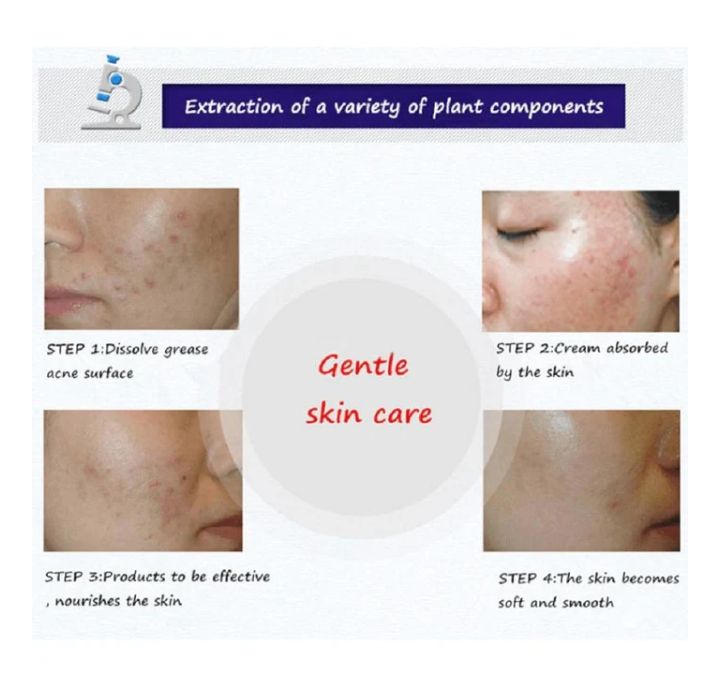 BIOAQUA Anti Acne Cleanser For Removal Of Acne - 100ml View Gallery - Pakistan