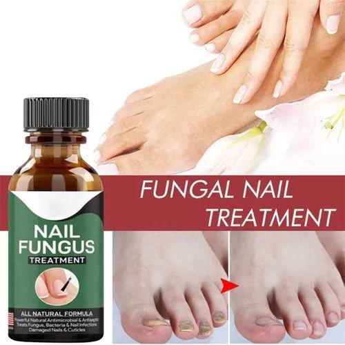 Fast Nail Fungal Treatments Nail Repair Essences Serum Care Treatments Foot Nail Fungus Removal Gel View Gallery - Pakistan