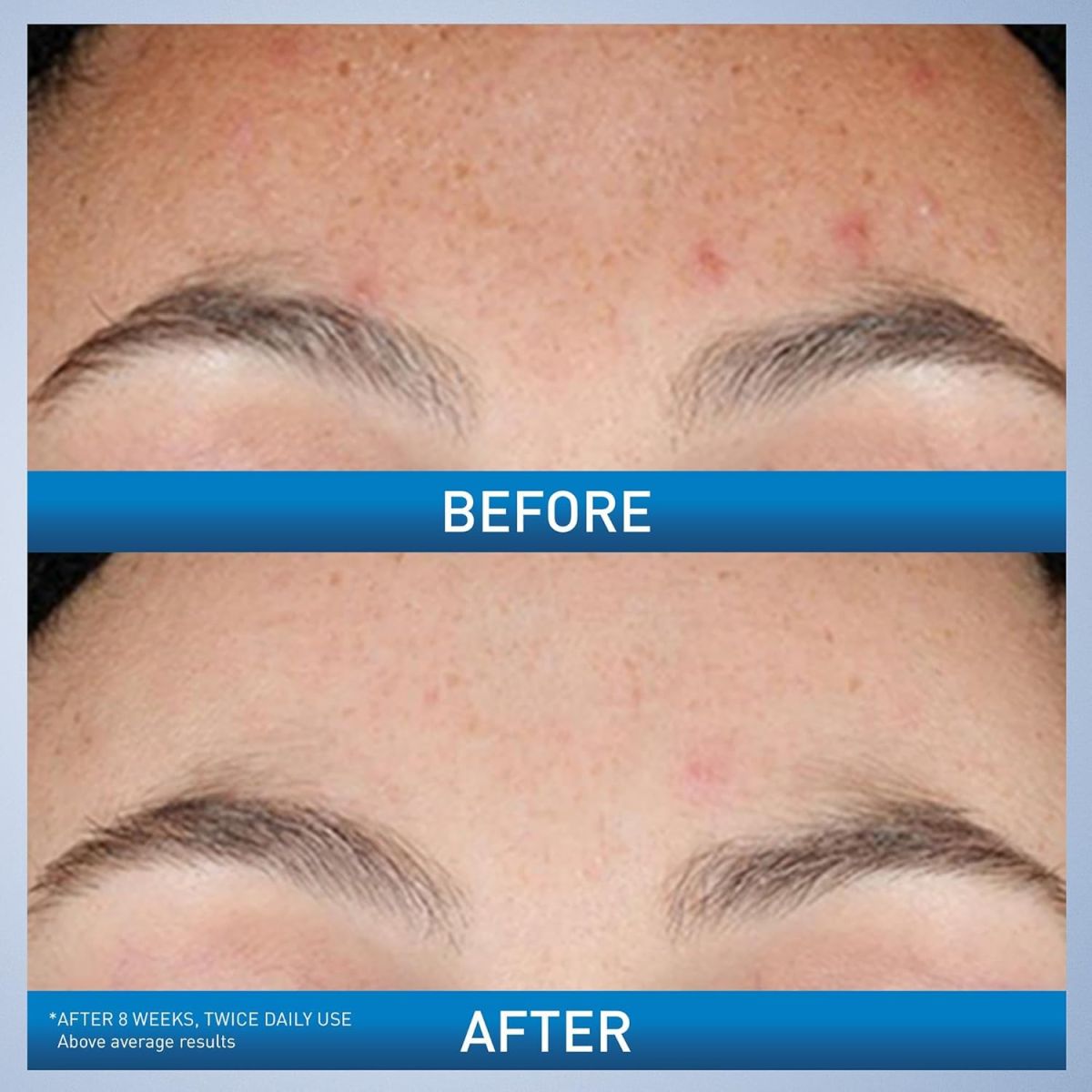 CeraVe Resurfacing Retinol Serum For Post Acne Marks, Formulated With Licorice Root Extract &amp; Niacinamide, Brightening Serum &amp; Pore Minimizer For Face, Post Acne Skin Barrier Repair, Non-Comedogenic - 30ml View Gallery - Pakistan