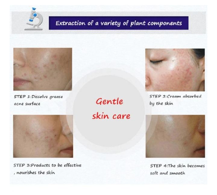 BIOAQUA Anti Acne Cream Acne Scar Removal Cream | Best Quality Scar Removal Cream 30g( Original ) View Gallery - Pakistan