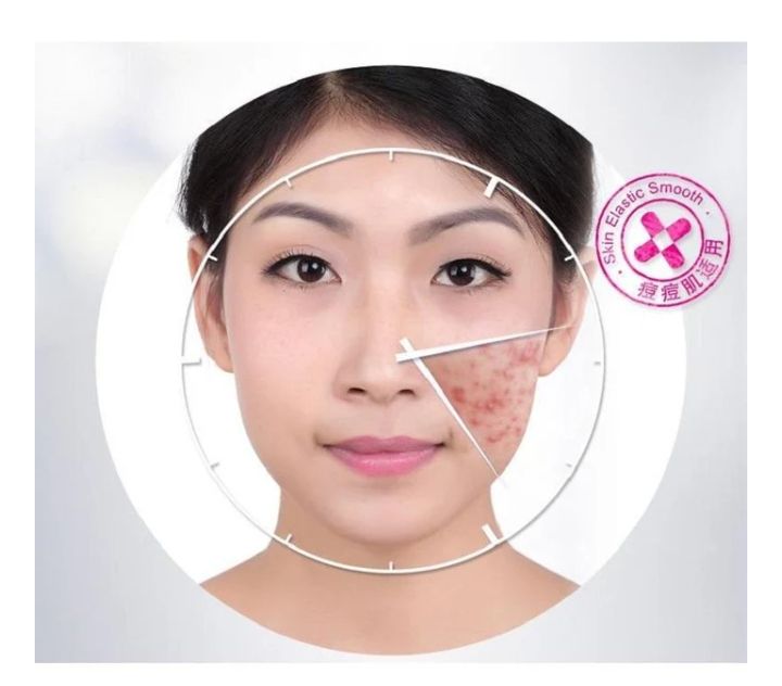 BIOAQUA Anti Acne Cream Acne Scar Removal Cream | Best Quality Scar Removal Cream 30g( Original ) View Gallery - Pakistan