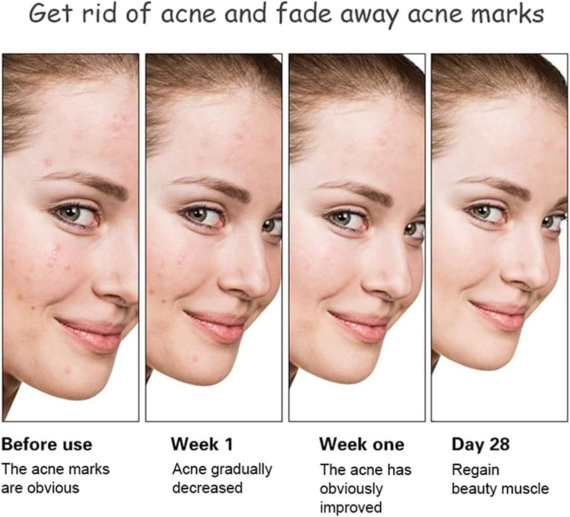 Aichun Beauty Anti - Acne Whitening Facial Serum Aloe Vera Extract Salicylic Acid Repairs Damaged Skin | 30ml View Gallery - Pakistan
