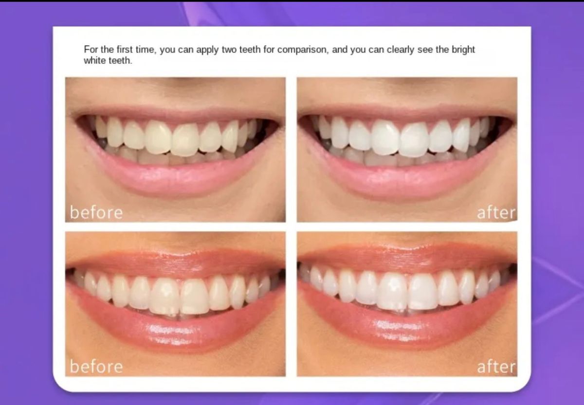 Teeth Brightening Hismiles V34 Colour Corrector Serum 30ml View Gallery - Pakistan
