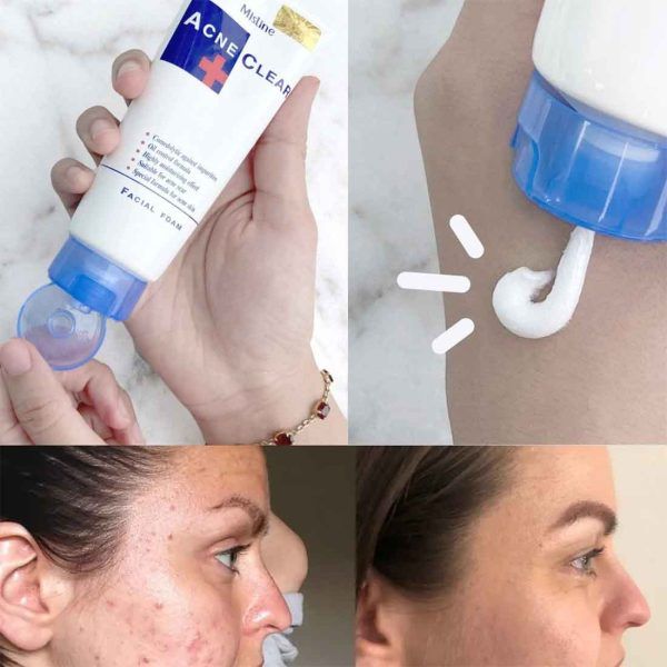 Mistine Acne Clear Face Wash Facial Foam 85 ml View Gallery - Pakistan