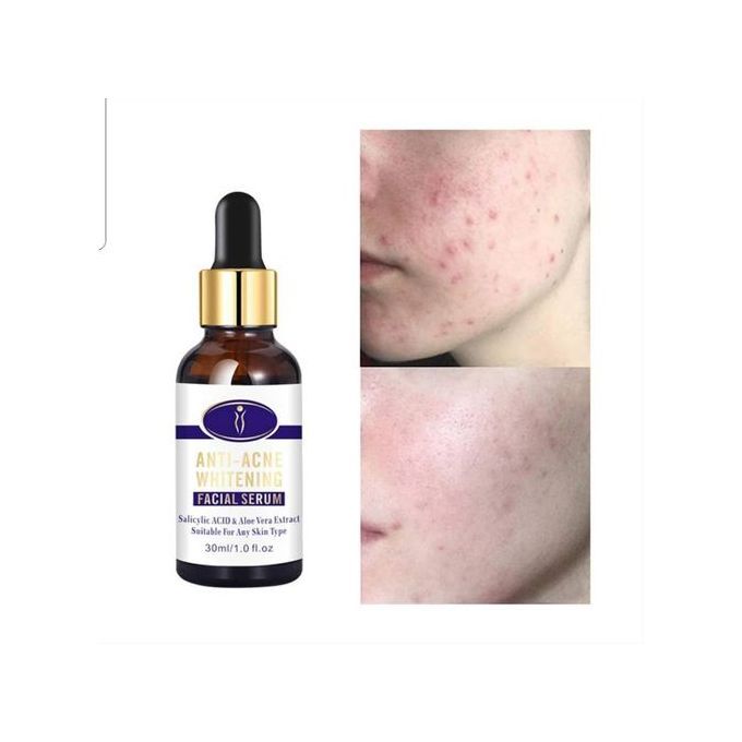 Aichun Beauty Medical Formula Anti-Acne Whitening Facial Serum-30ML View Gallery - Pakistan
