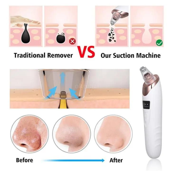 Face Vacuum Blackhead Remover Pore Cleaner | Electric Deep Cleansing Tool for Nose &amp; Face View Gallery - Pakistan