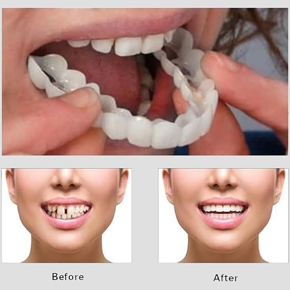 Snap On Smile - Veneers Teeth for Men and Women - Moldable False Artificial Braces Teeth View Gallery - Pakistan