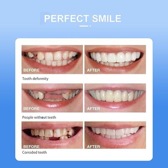 Snap On Smile - Veneers Teeth for Men and Women - Moldable False Artificial Braces Teeth View Gallery - Pakistan