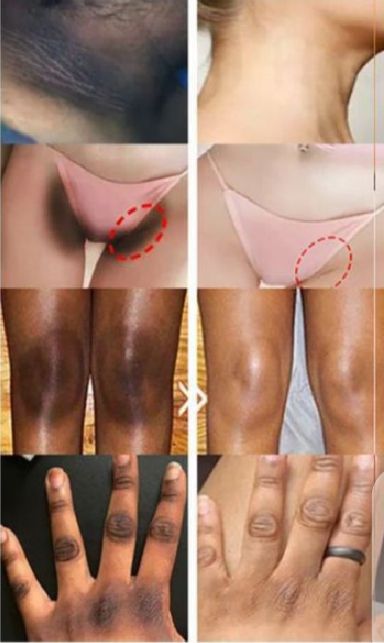 Whitening Cream for sensitive Areas underarm and private Areas - 30g View Gallery - Pakistan