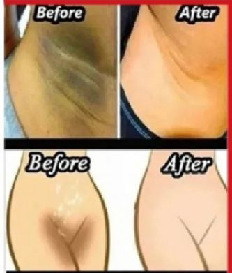 Whitening Cream for sensitive Areas underarm and private Areas - 30g View Gallery - Pakistan
