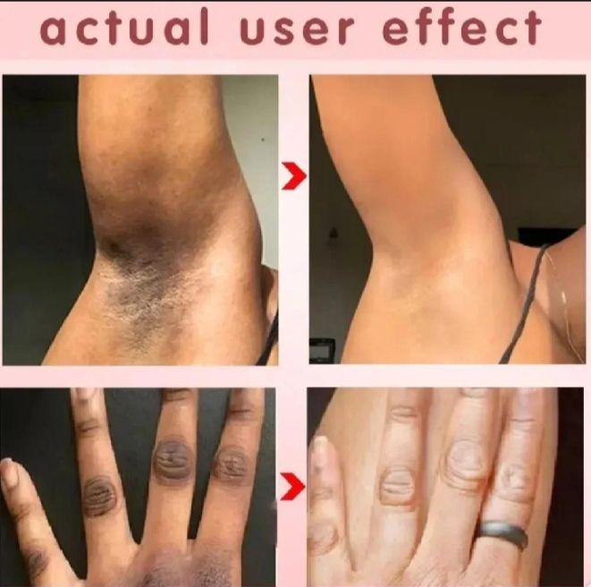 Whitening Cream for sensitive Areas underarm and private Areas - 30g View Gallery - Pakistan