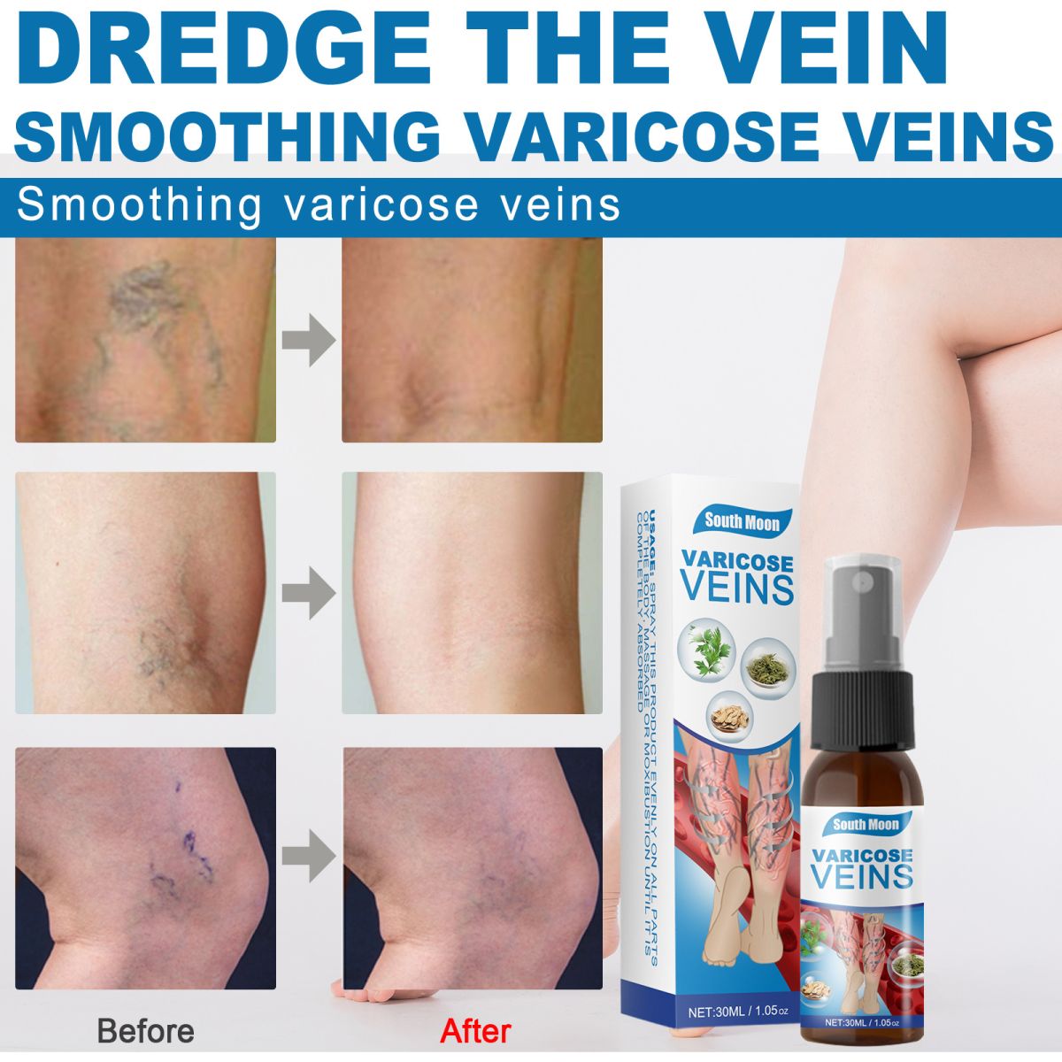 30ml Varicose Veins Treatment Spray Varicose Vein Treatment Cream Repair Varicocele Removal Pain Relief Kidney Inflammation Legs Vein Health Care Spray View Gallery - Pakistan