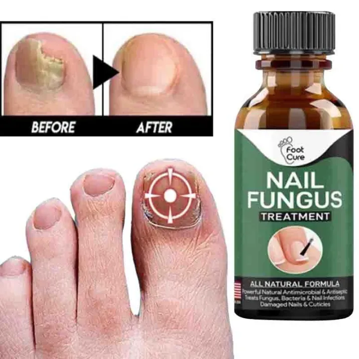 Fast Nail Fungal Treatments Nail Repair Essences Serum Care Treatments Foot Nail Fungus Removal Gel Paronychia Onychomycosis View Gallery - Pakistan