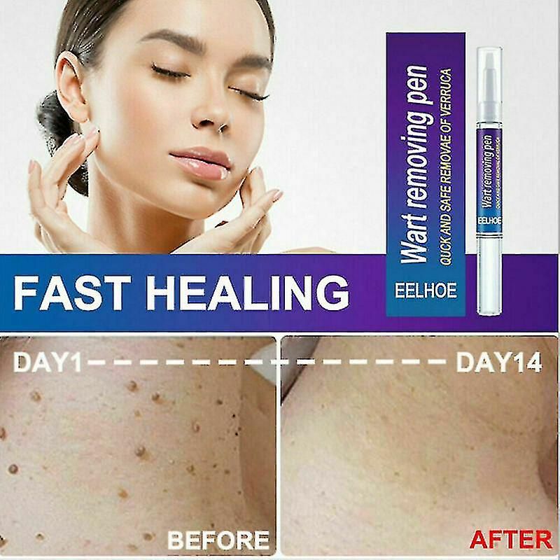 Warts Remover Original Cream Wart Removal Ointment Wart Treatment Skin Tag Mole Remover Antibacterial Foot Wart View Gallery - Pakistan