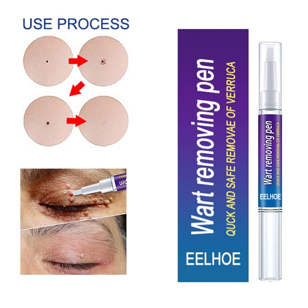 Warts Remover Original Cream Wart Removal Ointment Wart Treatment Skin Tag Mole Remover Antibacterial Foot Wart View Gallery - Pakistan