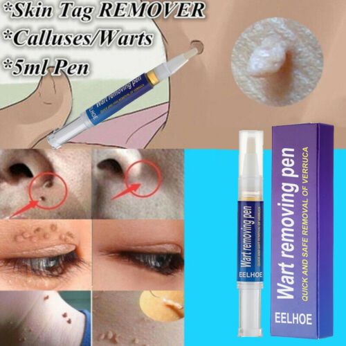 Warts Remover Original Cream Wart Removal Ointment Wart Treatment Skin Tag Mole Remover Antibacterial Foot Wart View Gallery - Pakistan